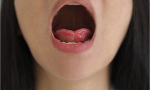 lingual frenectomy