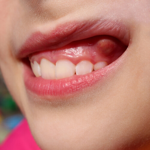 periapical abscess tooth abscess at home